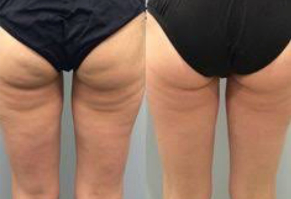 A woman's legs before and after she has had VelaShape treatment