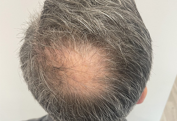 A man's head before he has had scalp micropigmentation treatment